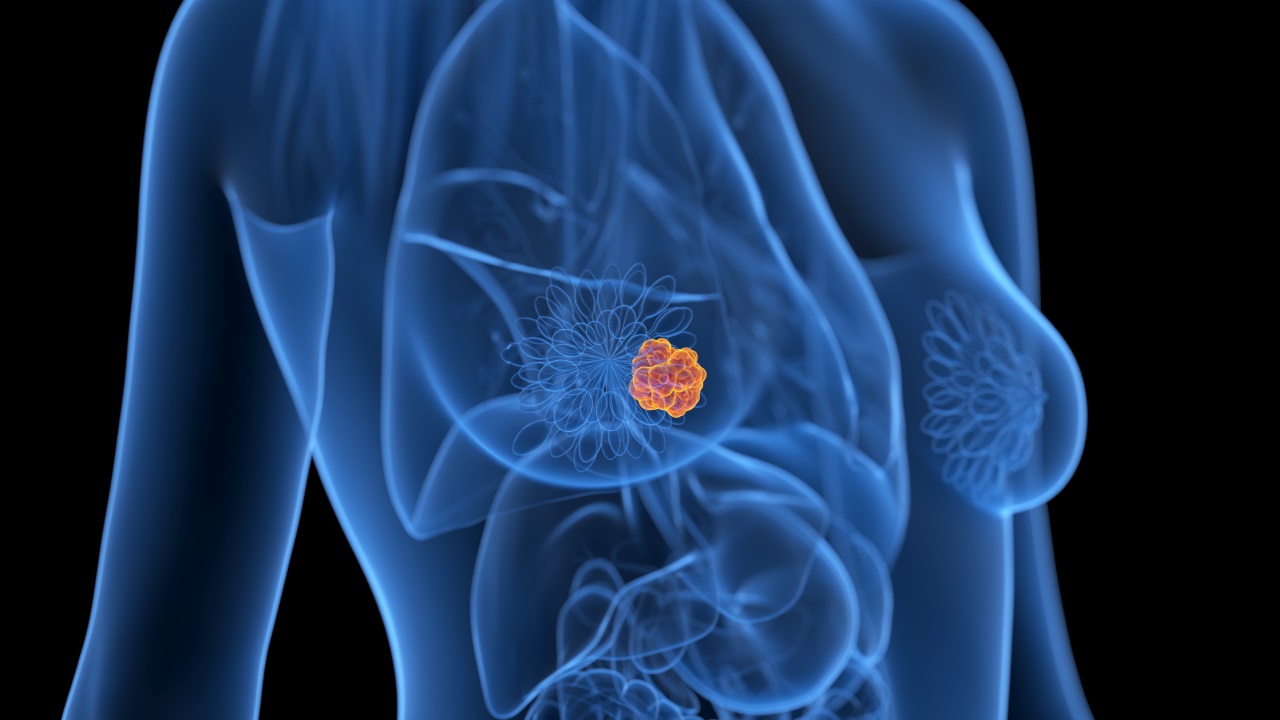 De-escalonamento do tratamento axilar em biópsia positiva de linfonodo sentinela em câncer de mama cT1-2 N0 tratado com mastectomia: estudo de registro nacional (BOOG 2013-07)